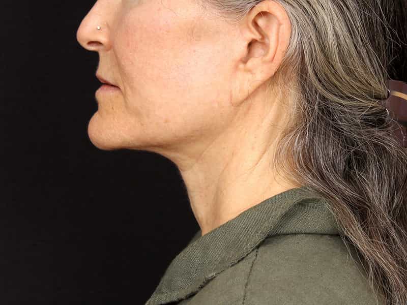 Necklift Before & After Image