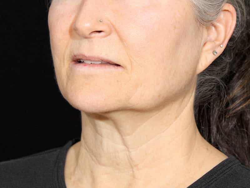 Necklift Before & After Image