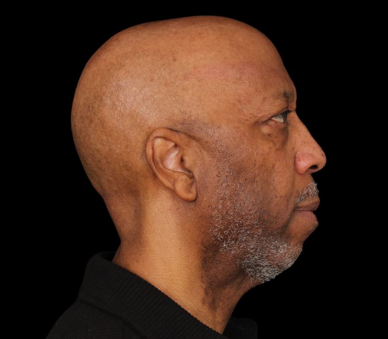 Necklift Before & After Photo