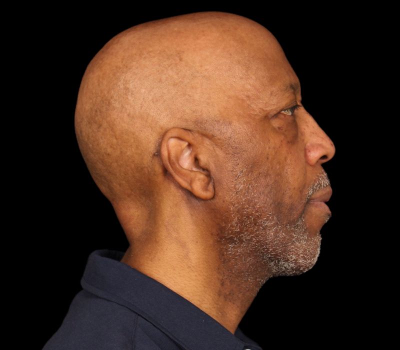 Necklift Before & After Photo