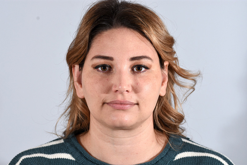 Otoplasty Before & After Photo