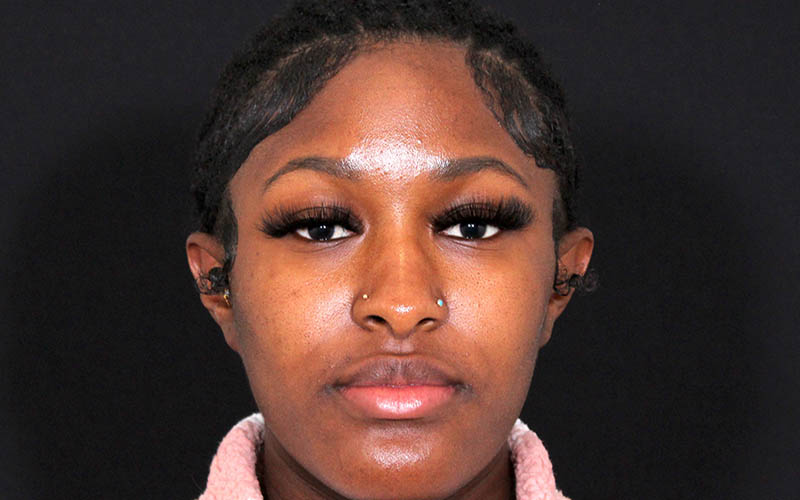 Otoplasty Before & After Photo