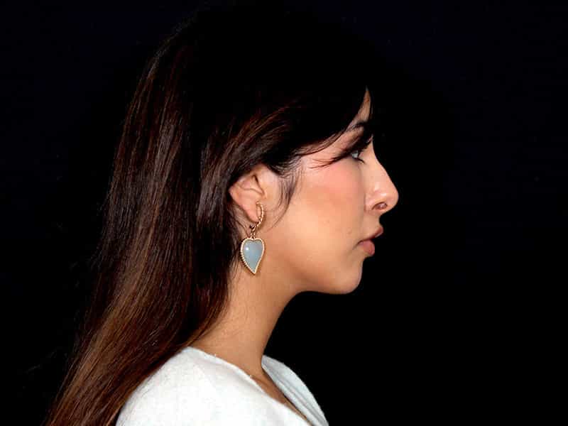 Rhinoplasty Before & After Photo