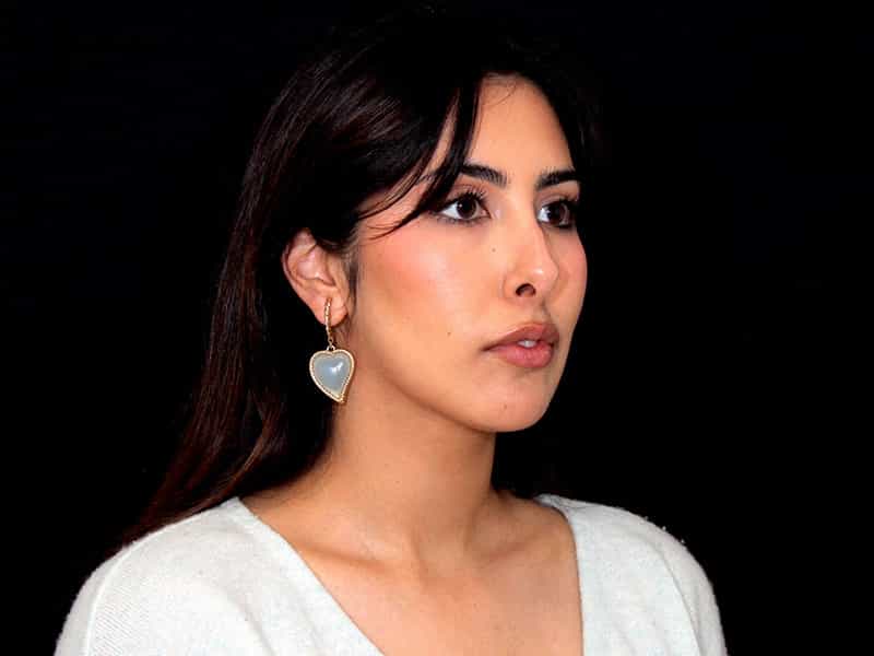 Rhinoplasty Before & After Image