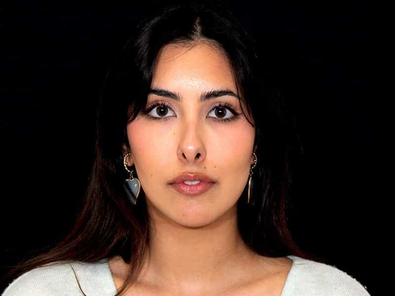 Rhinoplasty Before & After Image