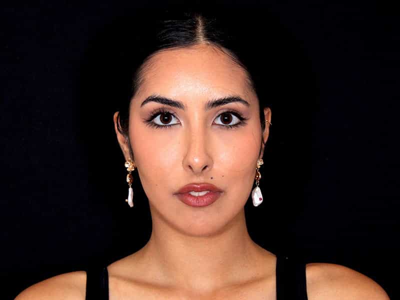 Rhinoplasty Before & After Image