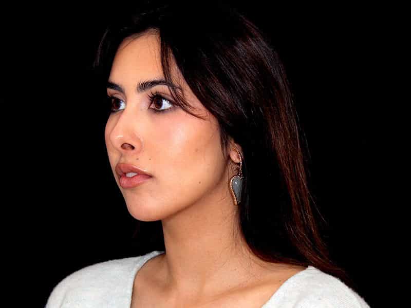Rhinoplasty Before & After Image