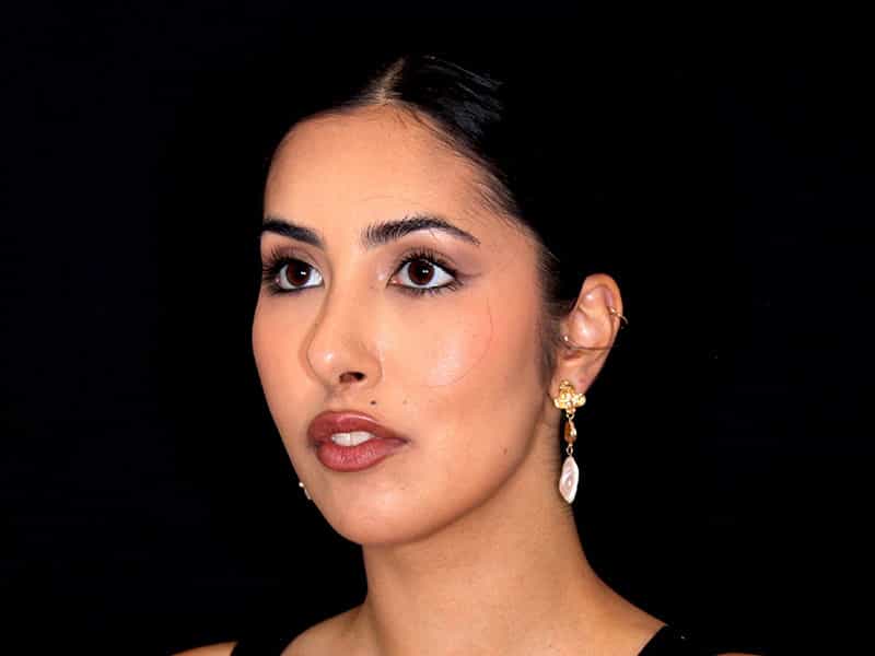 Rhinoplasty Before & After Image