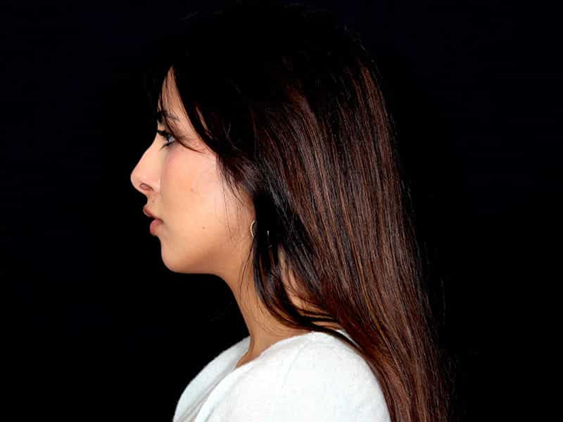 Rhinoplasty Before & After Image