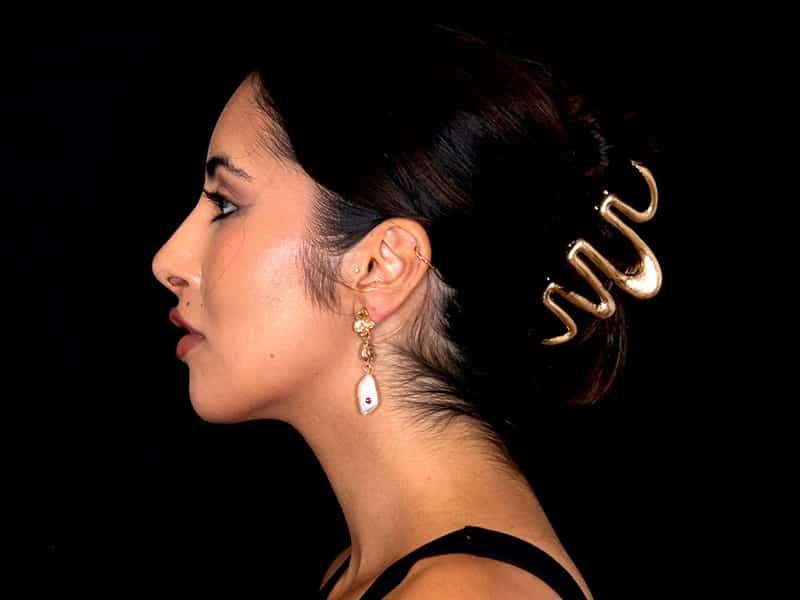 Rhinoplasty Before & After Image