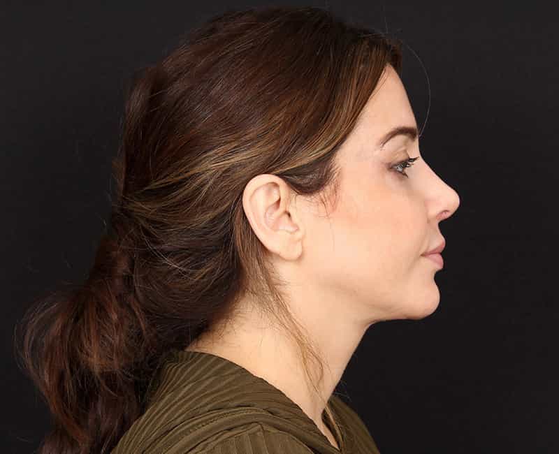 Rhinoplasty Before & After Photo