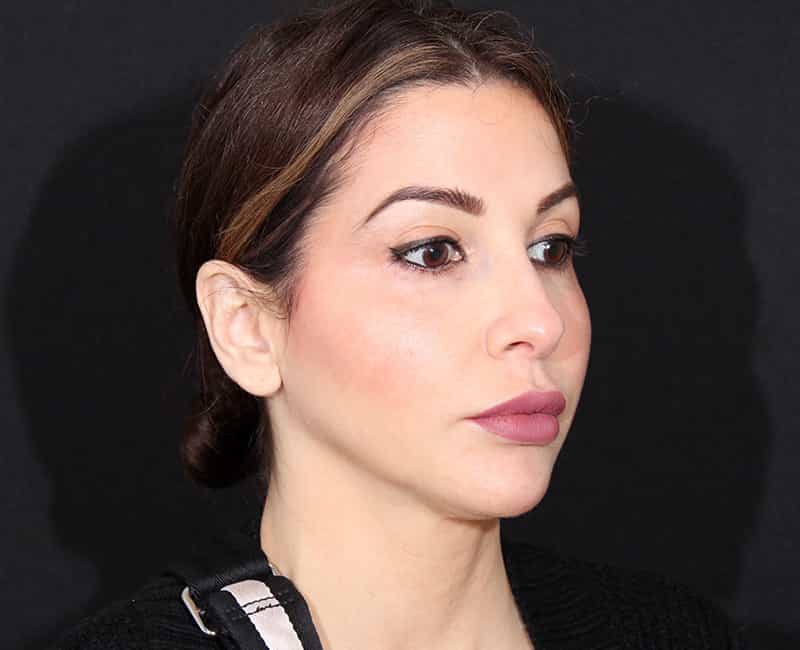 Rhinoplasty Before & After Image