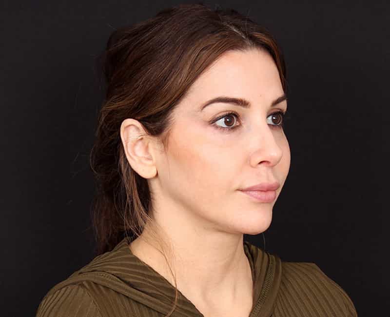 Rhinoplasty Before & After Image