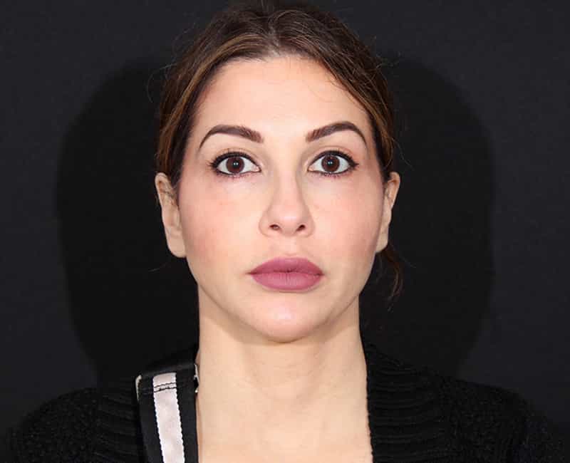 Rhinoplasty Before & After Image