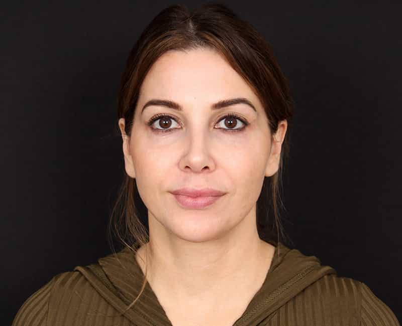 Rhinoplasty Before & After Image