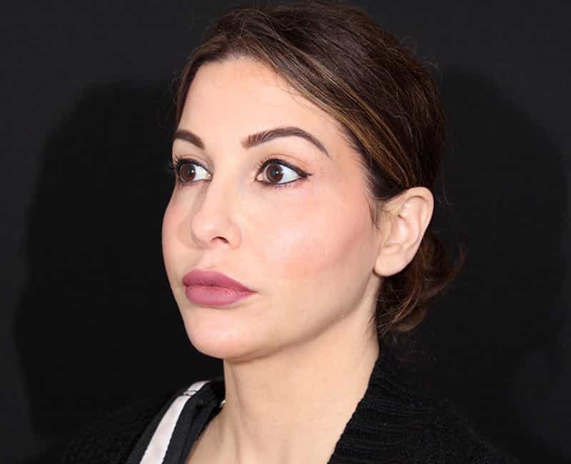 Rhinoplasty Before & After Image