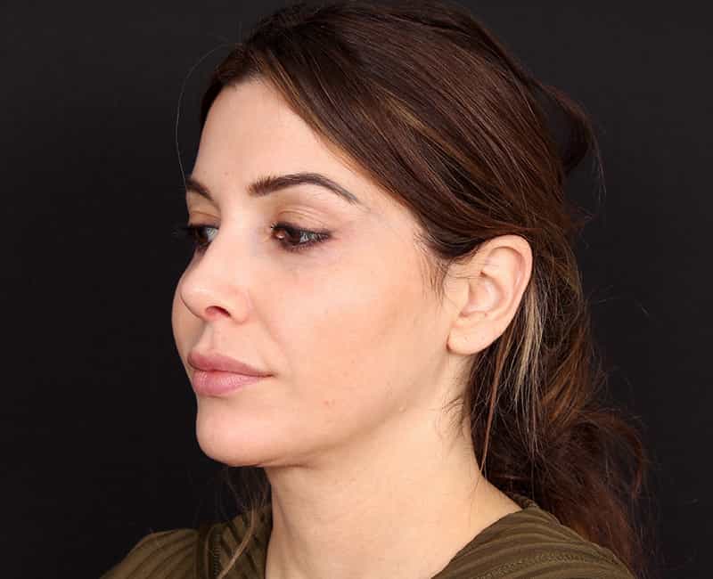 Rhinoplasty Before & After Image