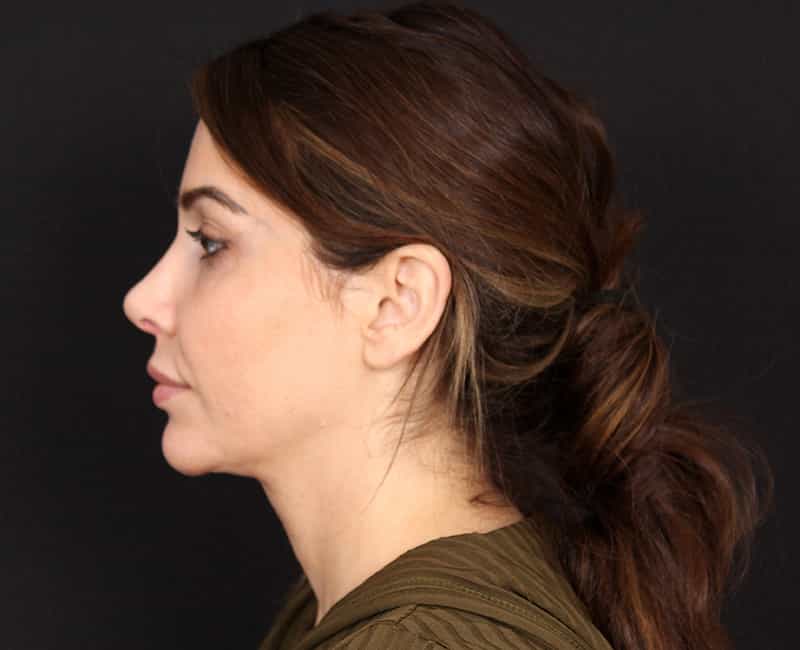 Rhinoplasty Before & After Image