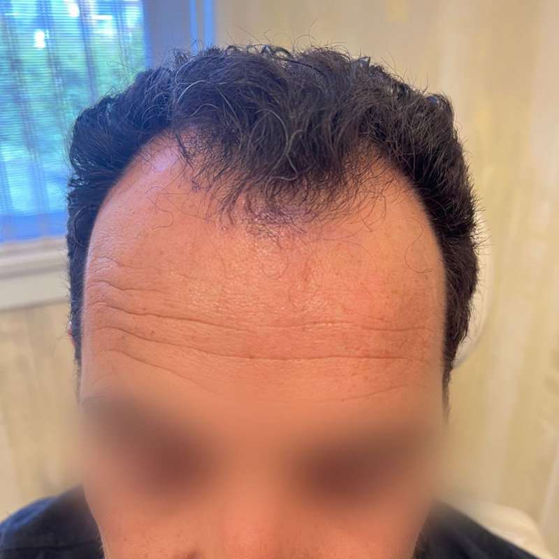 Hair Transplant Before & After Photo