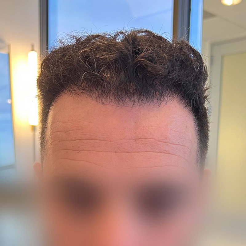 Hair Transplant Before & After Image