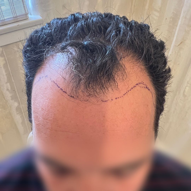 Hair Transplant Before & After Image