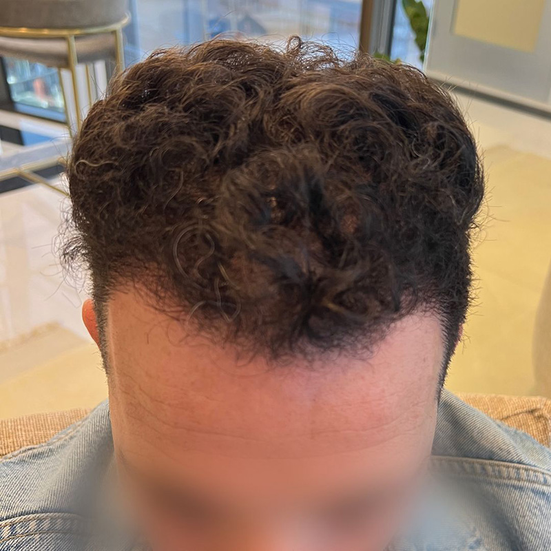 Hair Transplant Before & After Image