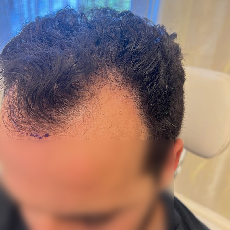 Hair Transplant Before & After Image