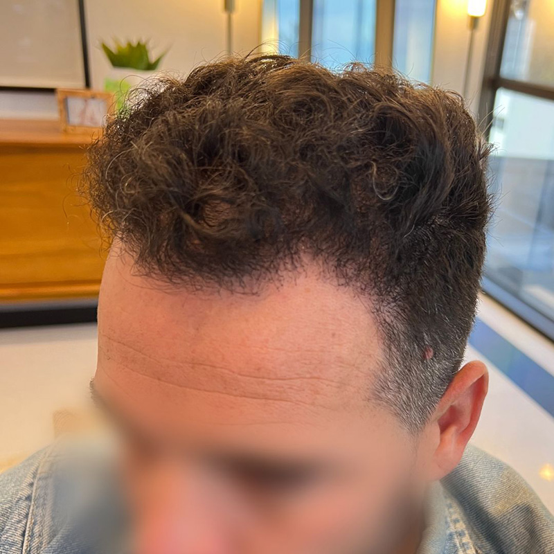 Hair Transplant Before & After Image