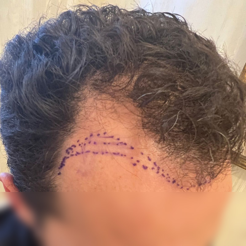 Hair Transplant Before & After Image