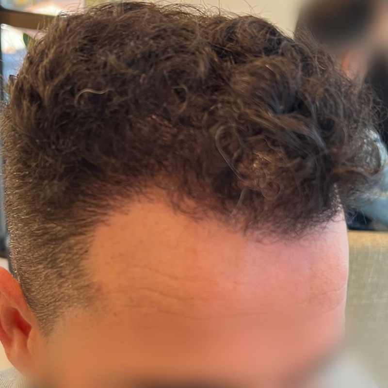 Hair Transplant Before & After Image