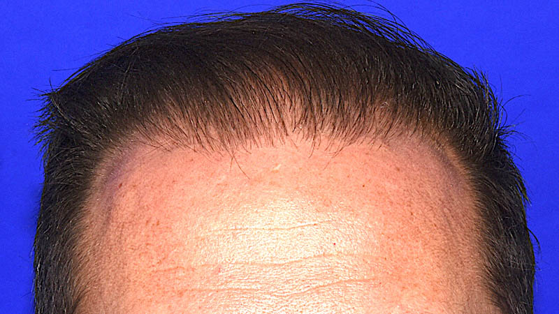Hair Transplant Before & After Photo