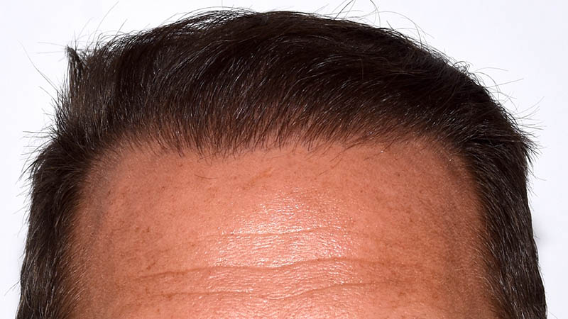 Hair Transplant Before & After Photo