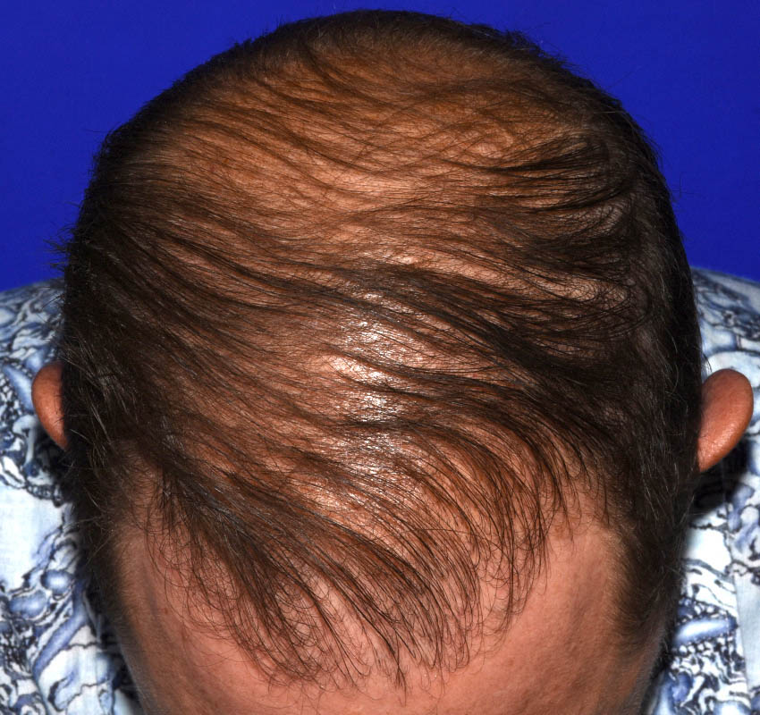 Hair Transplant Before & After Image