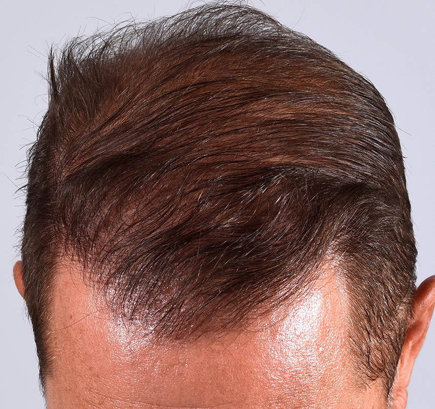 Hair Transplant Before & After Image
