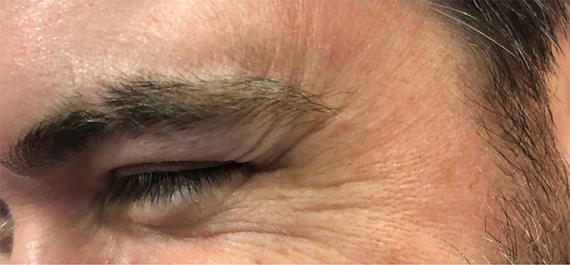 Botox Before & After Photo