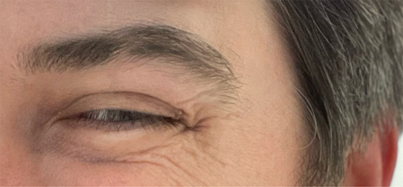 Botox Before & After Photo