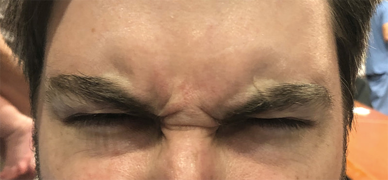 Botox Before & After Image