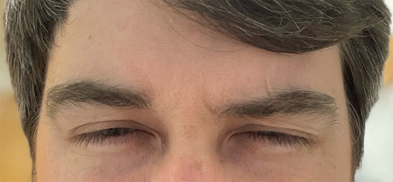 Botox Before & After Image