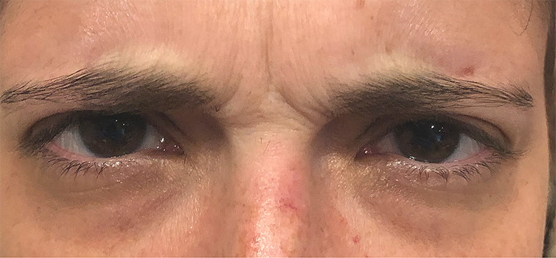 Botox Before & After Photo