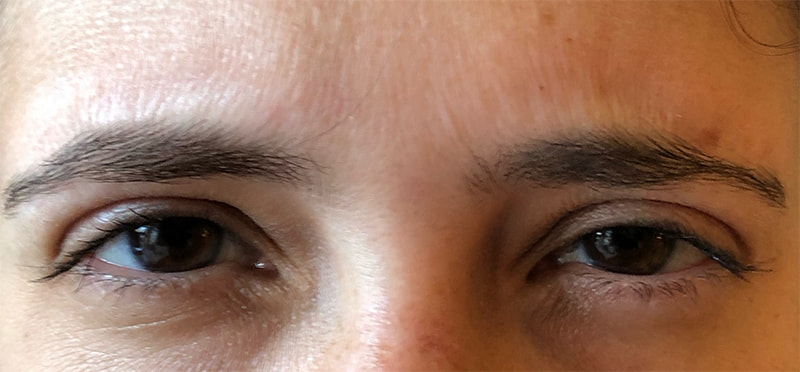 Botox Before & After Photo