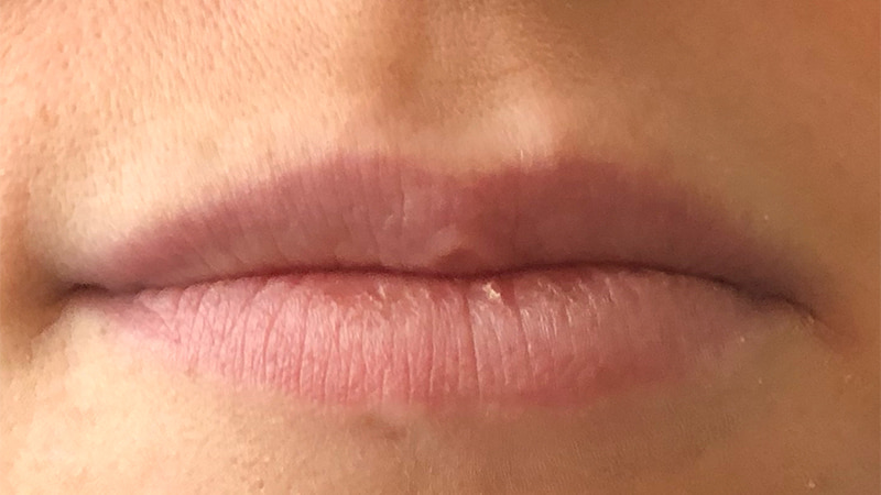 Dermal Fillers Before & After Photo