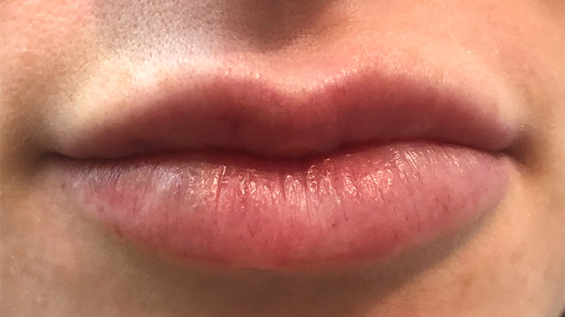 Dermal Fillers Before & After Photo