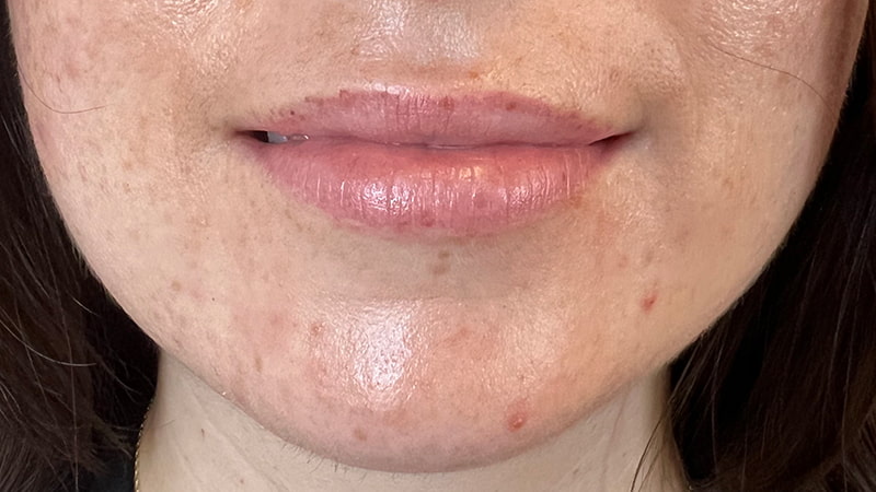 Dermal Fillers Before & After Photo