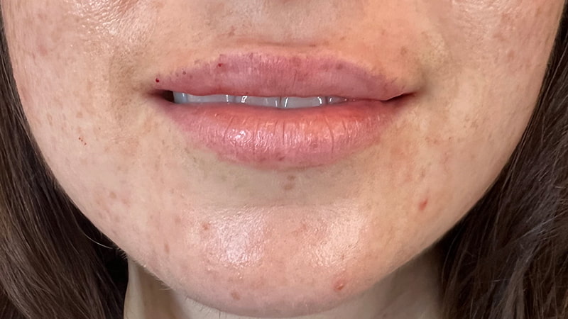 Dermal Fillers Before & After Photo