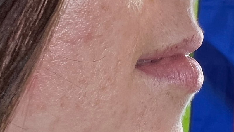 Dermal Fillers Before & After Image