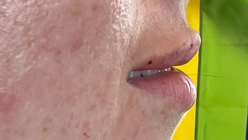 Dermal Fillers Before & After Image