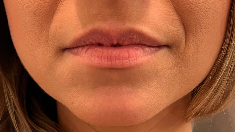 Dermal Fillers Before & After Photo