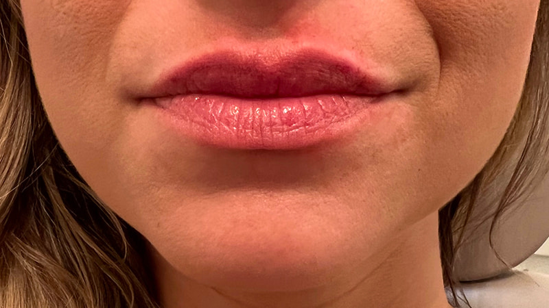 Dermal Fillers Before & After Photo
