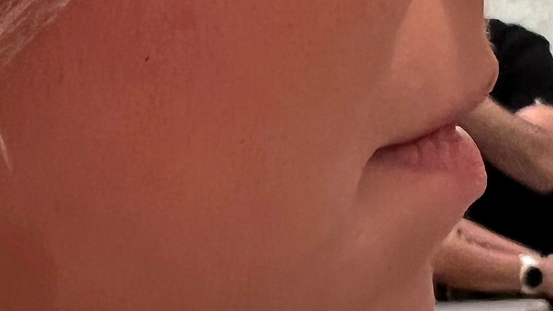 Dermal Fillers Before & After Image