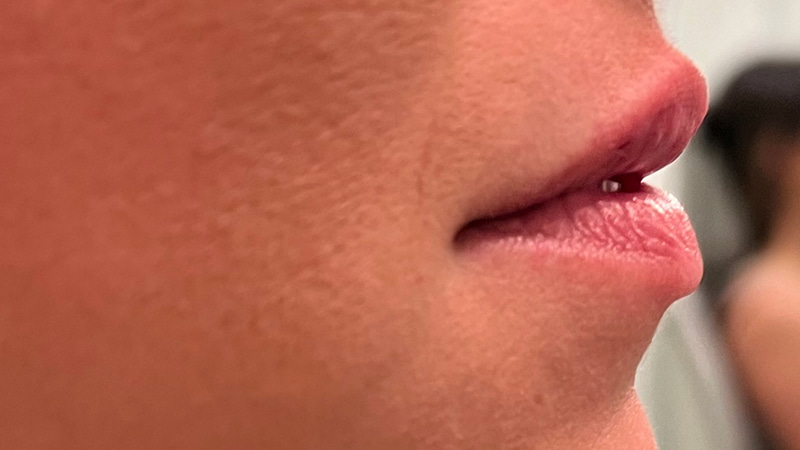 Dermal Fillers Before & After Image